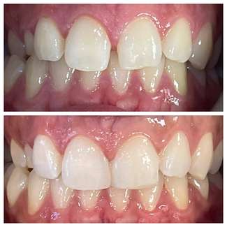 Patient smile transformation 1