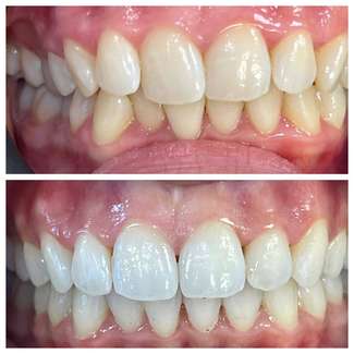 Patient smile transformation 3